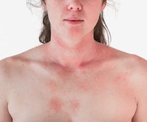 Dermatología - Eczema